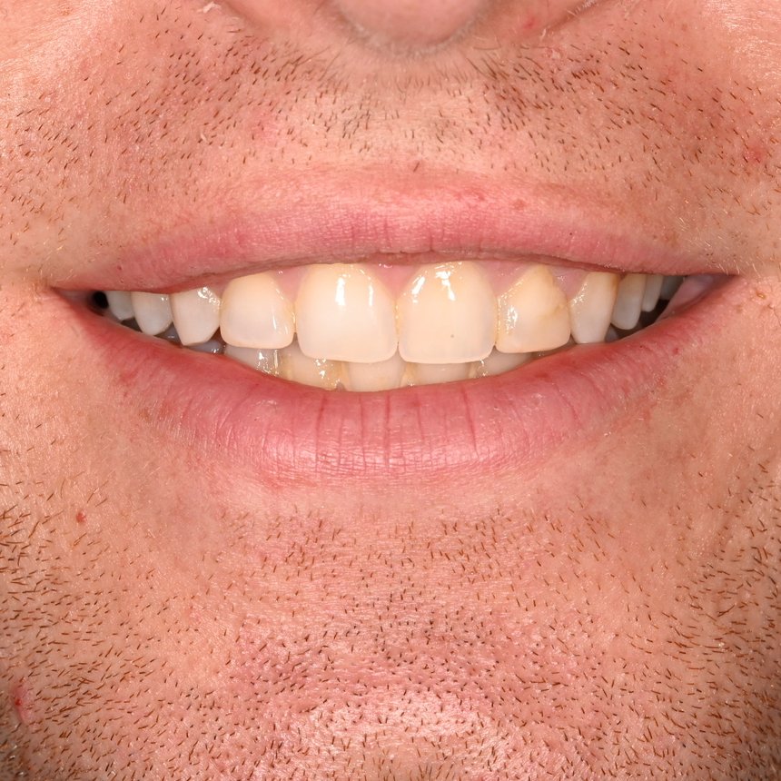 Before treatment
